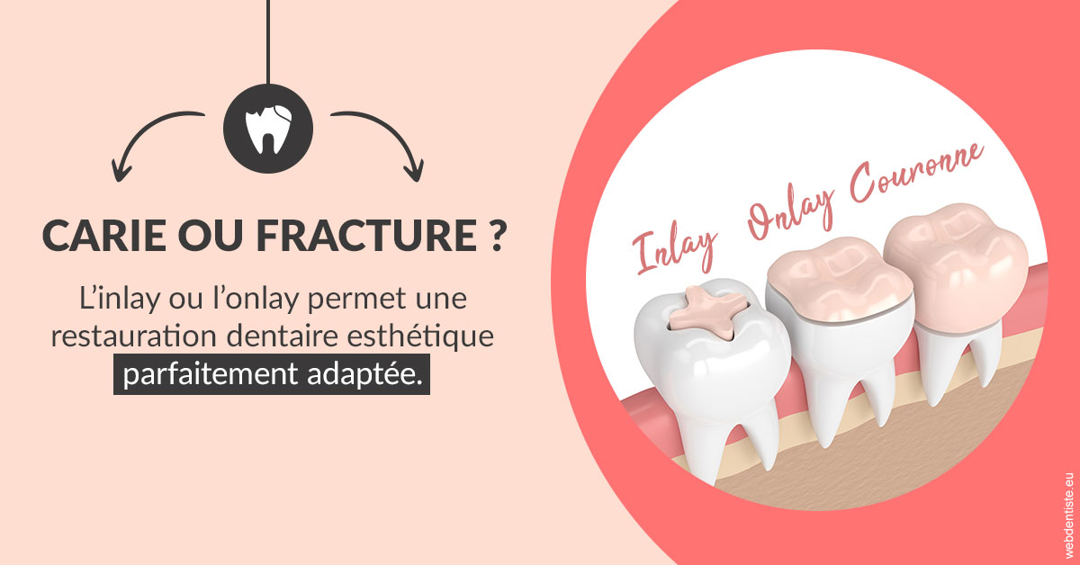 https://dr-trin-yves.chirurgiens-dentistes.fr/T2 2023 - Carie ou fracture 2