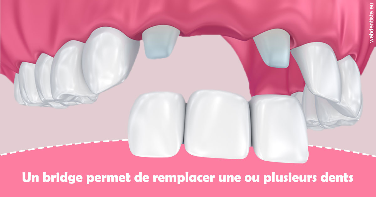 https://dr-trin-yves.chirurgiens-dentistes.fr/Bridge remplacer dents 2
