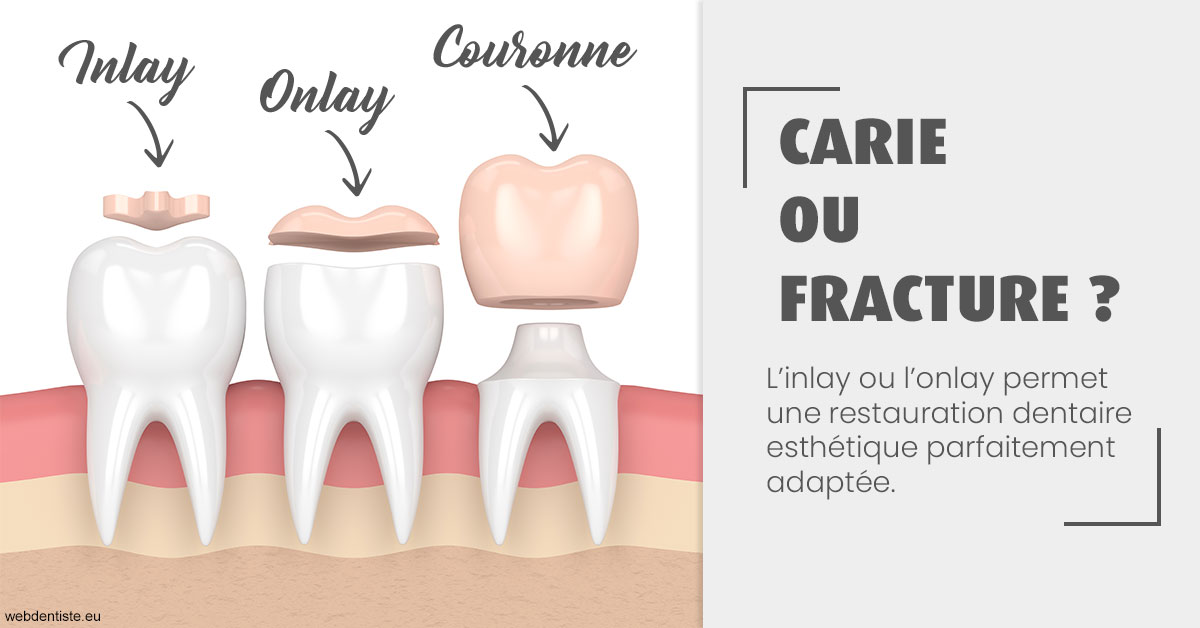 https://dr-trin-yves.chirurgiens-dentistes.fr/T2 2023 - Carie ou fracture 1