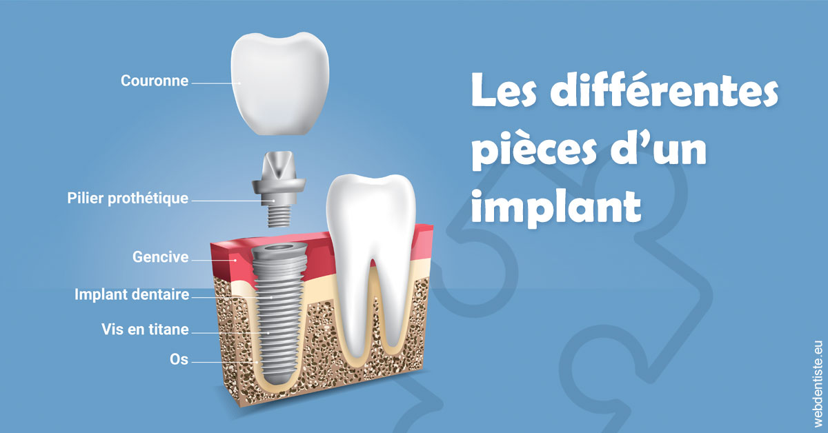 https://dr-trin-yves.chirurgiens-dentistes.fr/Les différentes pièces d’un implant 1